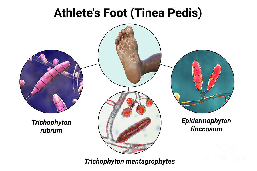 Athletes Foot #7 Photograph by Kateryna Kon/science Photo Library Athletes Foot #7 Photograph by Kateryna Kon/science Photo Library