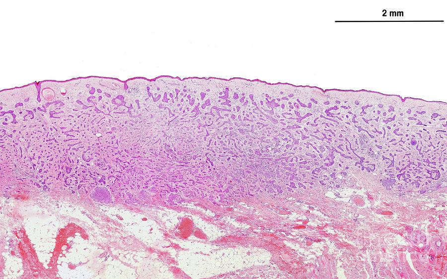 Basal Cell Carcinoma Photograph by Jose Calvo/science Photo Library ...