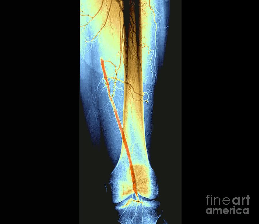 Blocked Femoral Artery #7 Photograph by Zephyr/science Photo Library