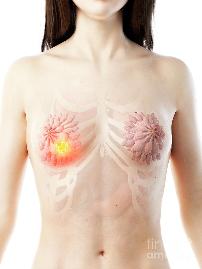 3d Photograph - Breast Cancer #7 by Sebastian Kaulitzki/science Photo Library