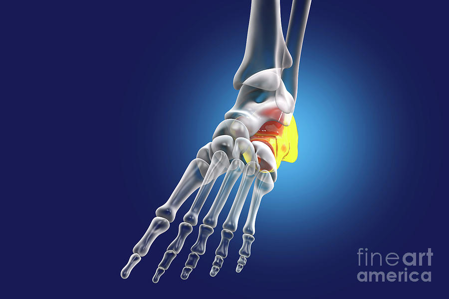 Calcaneus Bone Photograph by Kateryna Kon/science Photo Library - Fine ...