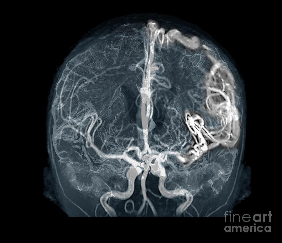 Cerebral Arteriovenous Malformation Photograph By Zephyr/science Photo ...