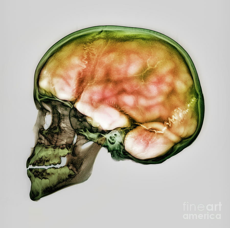 Skull Photograph - Childs Skull #7 by D. Roberts/science Photo Library
