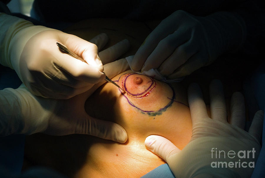 Breast Surgery Procedures Archives