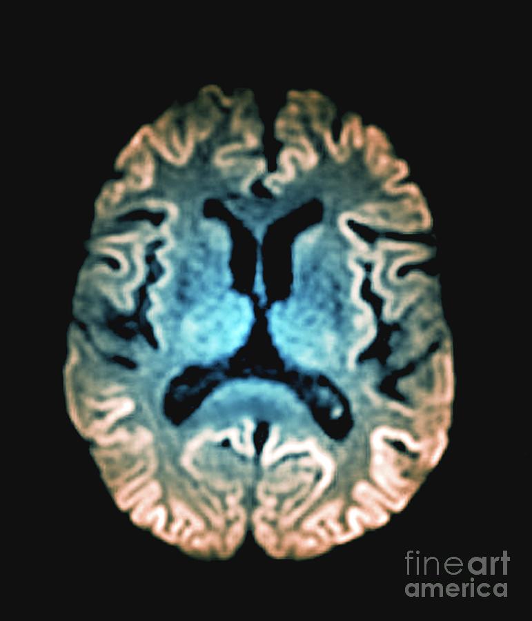 Creutzfeldtjakob Disease Photograph by Zephyr/science Photo Library