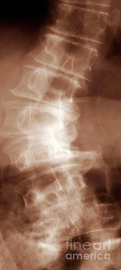 Diseased Spine #7 Photograph by Zephyr/science Photo Library
