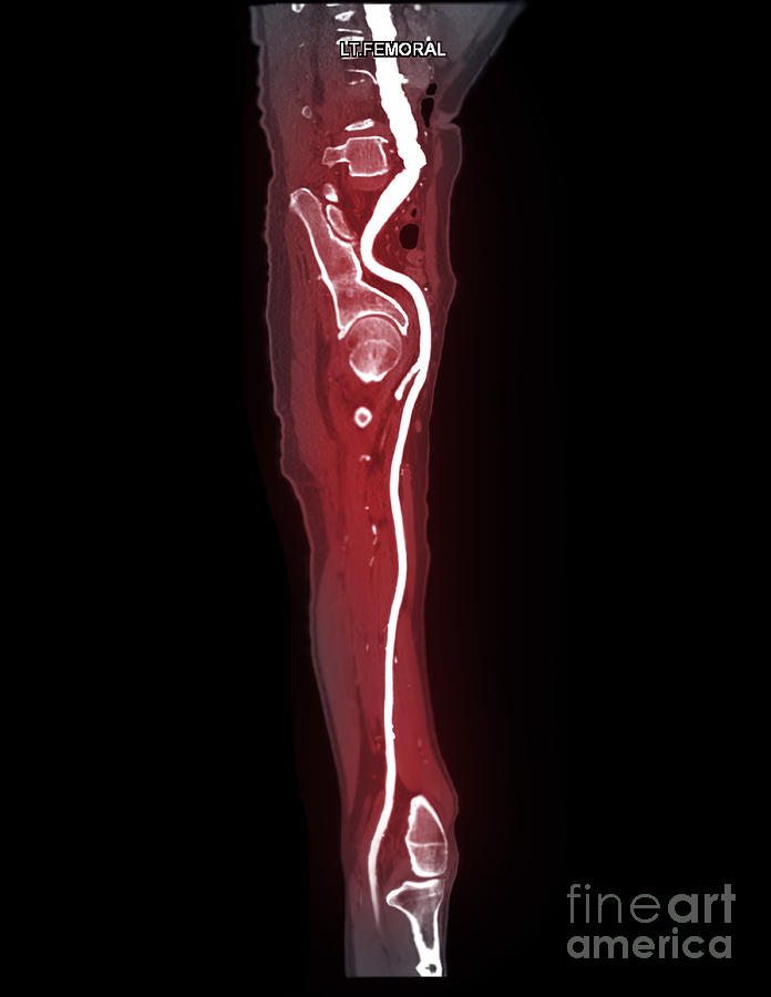 Femoral Artery #7 Photograph by Samunella/science Photo Library
