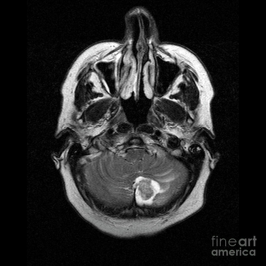Haemangioblastoma Brain Tumour #7 Photograph by Simon Fraser/science Photo Library