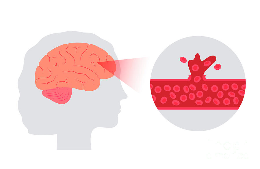 Haemorrhagic Stroke #7 Photograph by Pikovit / Science Photo Library ...