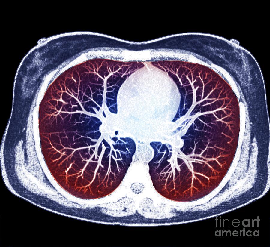 Heart And Lungs Photograph by Zephyr/science Photo Library - Fine Art ...