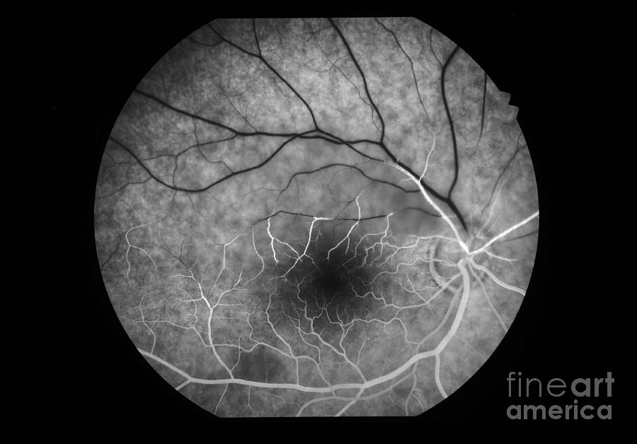 Hemispheric Retinal Artery Occlusion #7 Photograph by Alan ...