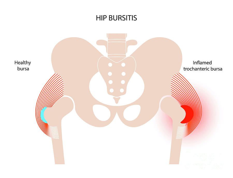 Bursitis of the hip joint - Stock Image - C011/0413 - Science Photo Library