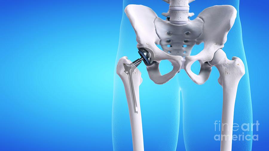 Hip Replacement Photograph By Sebastian Kaulitzki Science Photo Library