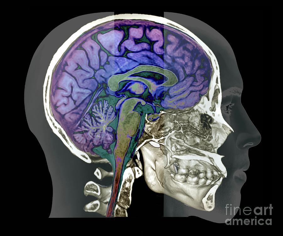 Железа мозга 7. Head Brain CT. Abcess Brain CT. Brain CT gif.