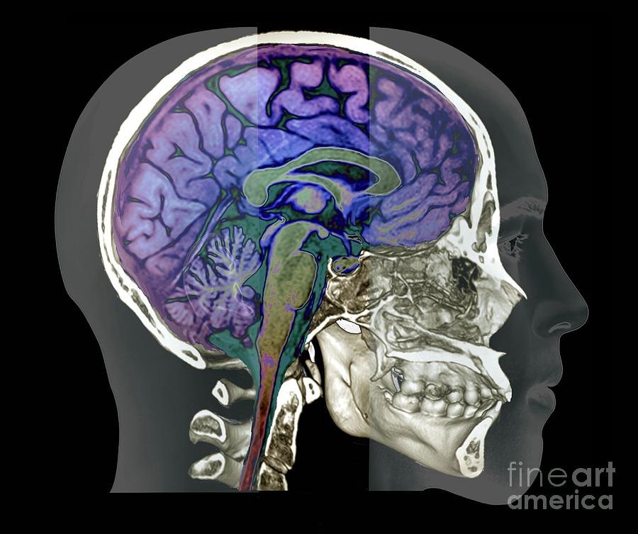 Brains 7. Abcess Brain CT.