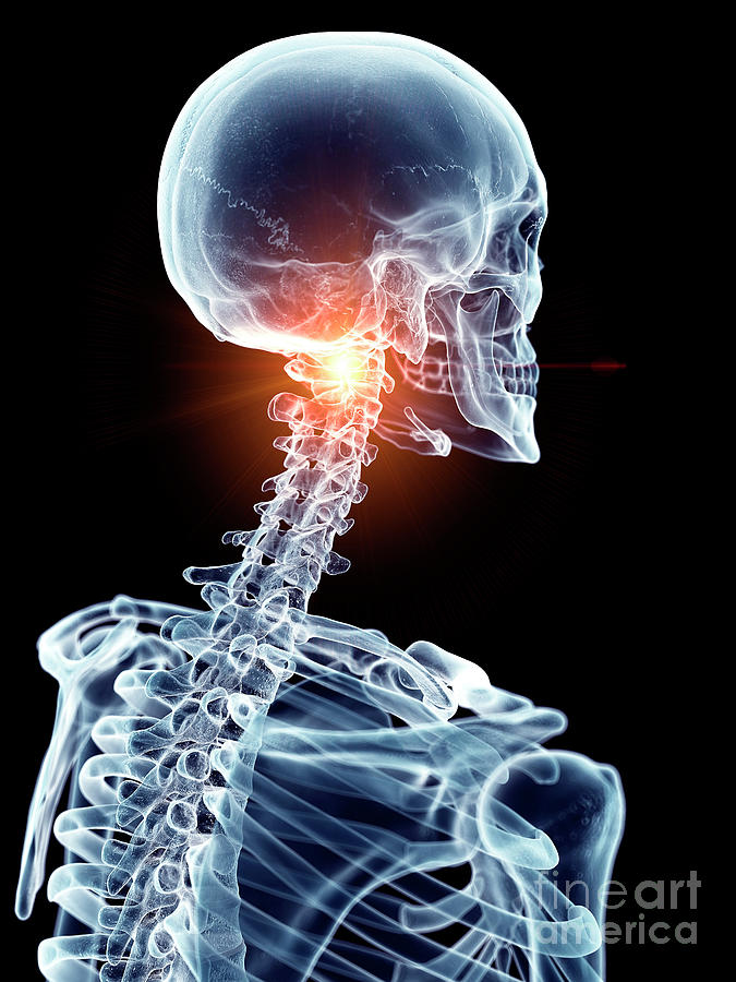 Illustration Of A Painful Cervical Spine #7 by Sebastian Kaulitzki ...