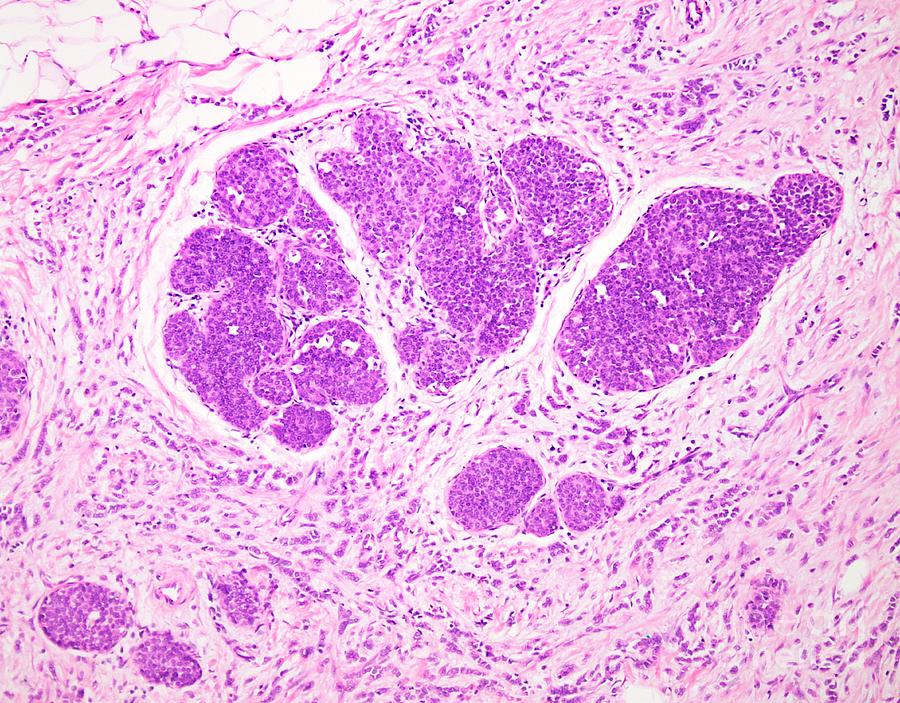 Invasive Lobular Carcinoma