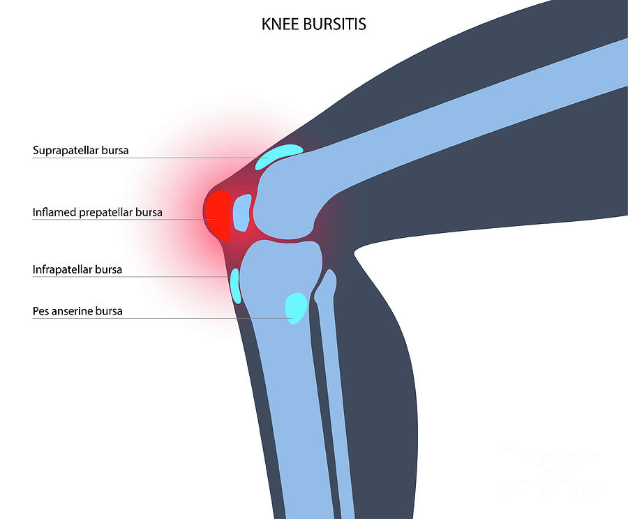 Knee Bursitis Photograph by Pikovit / Science Photo Library Fine Art