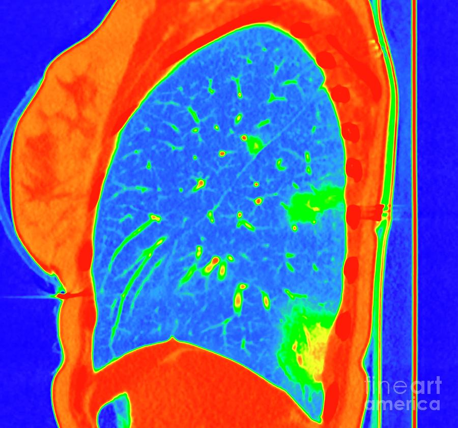 Lung Affected By Covid-19 Pneumonia Photograph by Vsevolod Zviryk ...