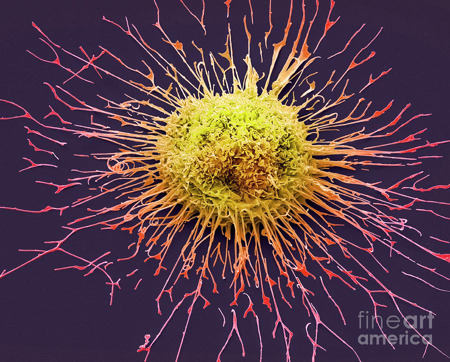 Adenocarcinoma Photograph - Lung Cancer Cell #7 by Steve Gschmeissner/science Photo Library