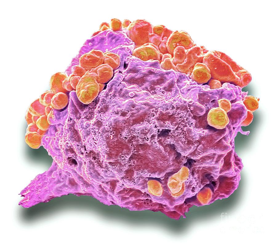 Lymphoma Cancer Cell Photograph by Steve Gschmeissner/science Photo ...