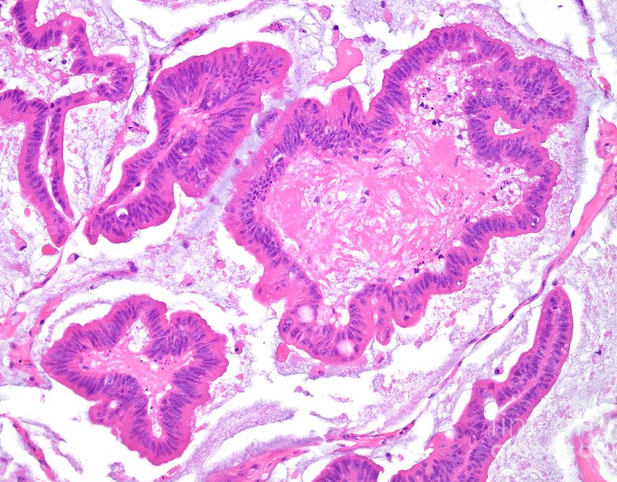 Mucinous Carcinoma Of The Colon Photograph by Webpathology/science ...