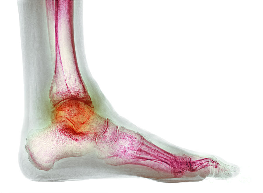 Osteoarthritis Of The Ankle Photograph By Dr P Marazzi Science Photo Library