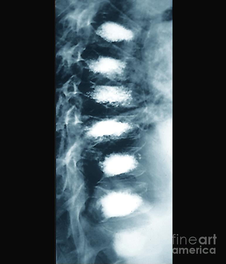 Osteoporosis Of The Spine With Vertebroplasty #7 by Zephyr/science ...