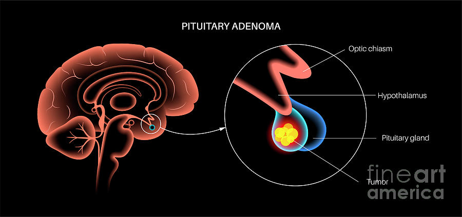 Pituitary Tumor