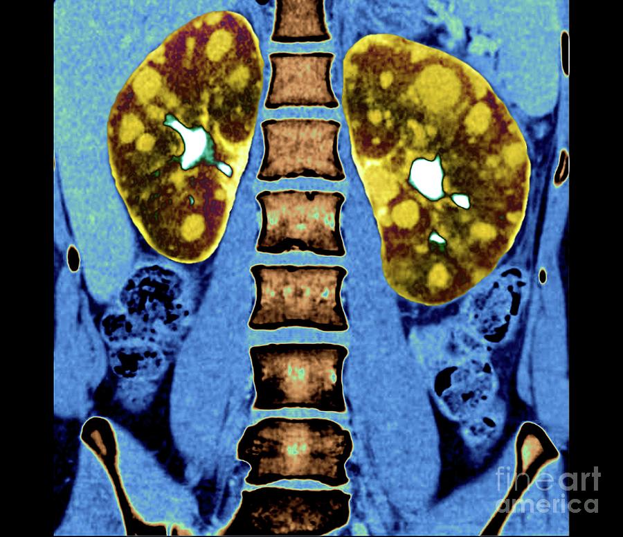 Polycystic Kidneys Photograph by Zephyr/science Photo Library - Fine ...