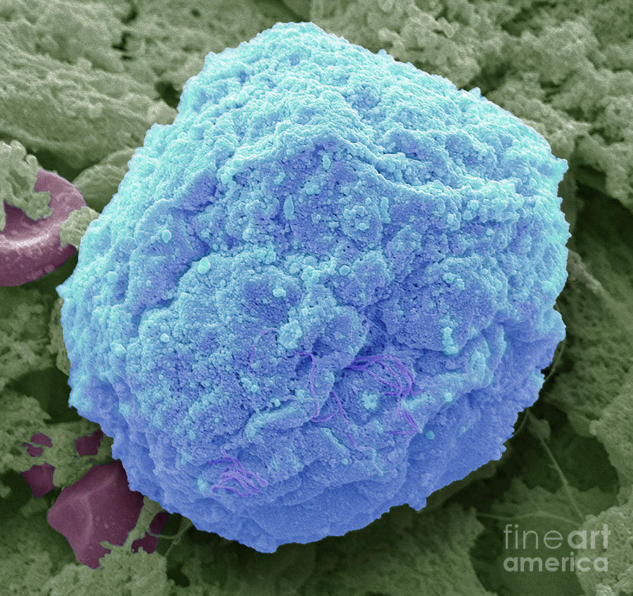 Sarcoma #7 Photograph by Steve Gschmeissner/science Photo Library