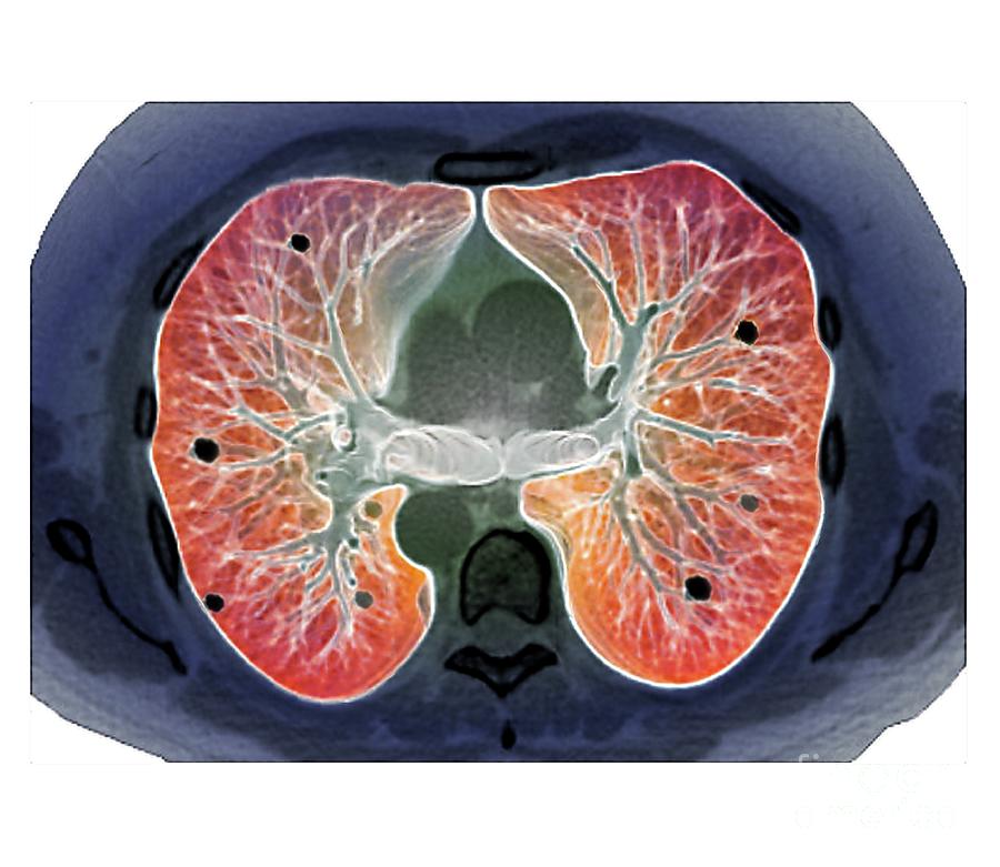 Secondary Lung Cancer Photograph by Zephyr/science Photo Library - Fine ...