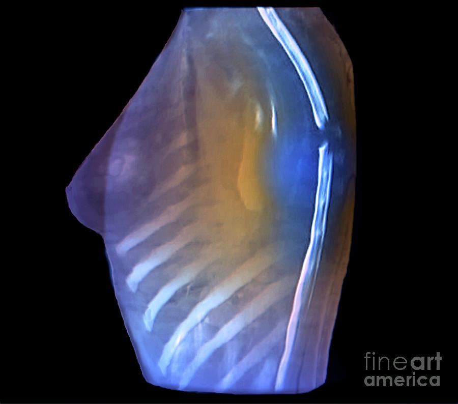 Back Photograph - Spinal Cord Tumour #7 by Zephyr/science Photo Library