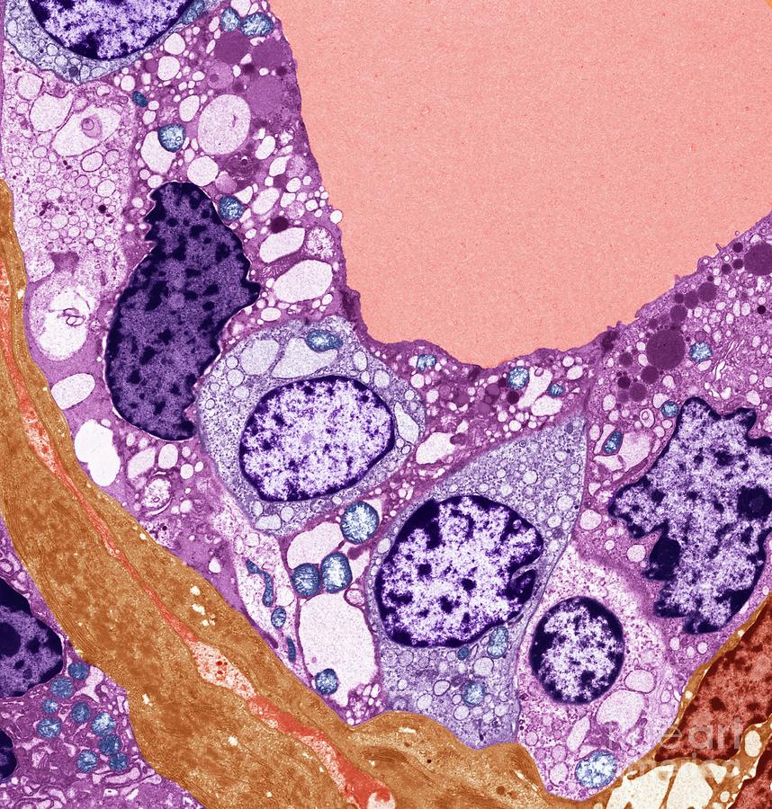 Thyroid Cancer Photograph by Steve Gschmeissner/science Photo Library ...