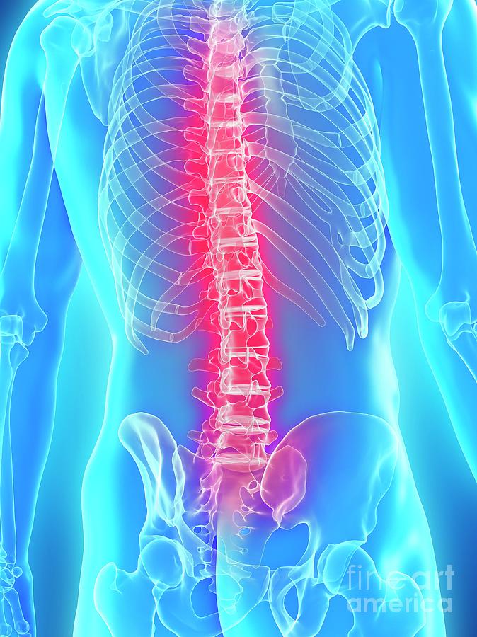 Skeleton Photograph - Back Pain #78 by Sebastian Kaulitzki/science Photo Library