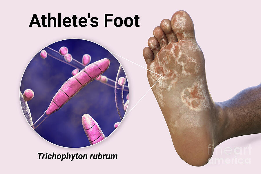 Athletes Foot #8 Photograph by Kateryna Kon/science Photo Library Athletes Foot #8 Photograph by Kateryna Kon/science Photo Library