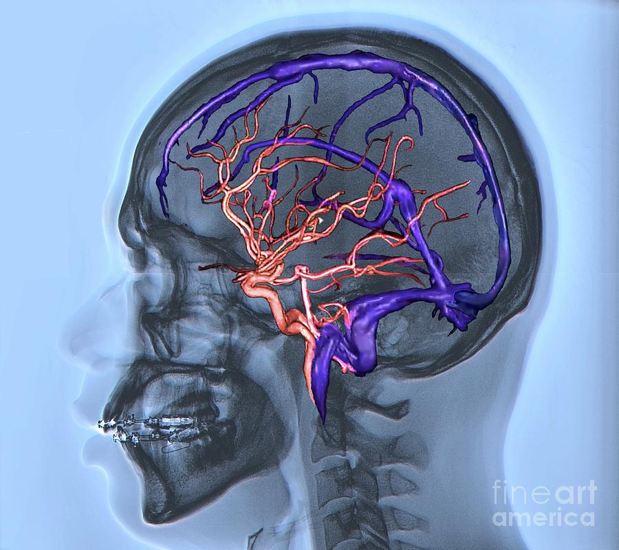 Brain Arteries And Venous Sinuses Photograph by Zephyr/science Photo ...