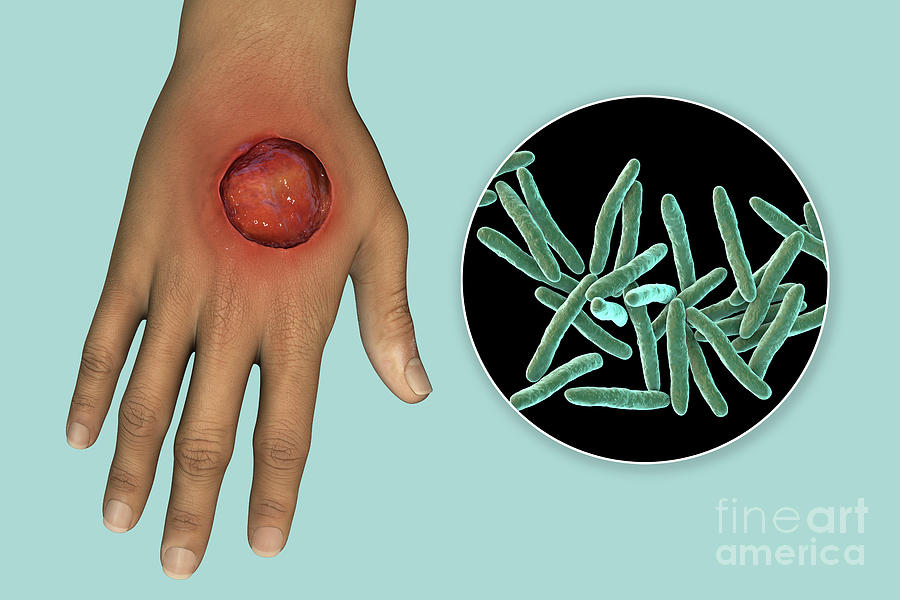 Buruli Ulcer And Mycobacterium Ulcerans Photograph By Kateryna Kon ...