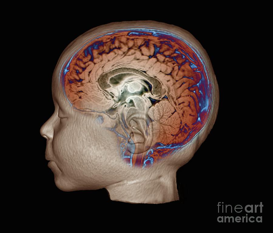 Childs Head And Brain #8 Photograph by Zephyr/science Photo Library
