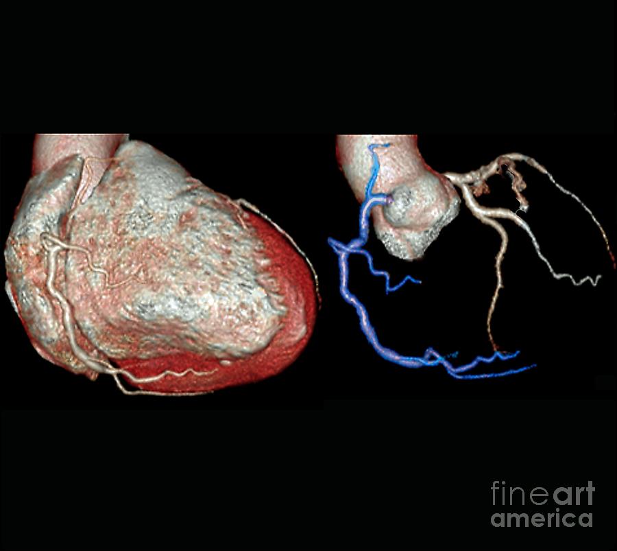 Coronary Artery Evaluation Photograph by Zephyr/science Photo Library