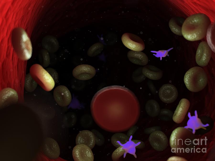 3d Photograph - Diseased Blood Cells by Sebastian Kaulitzki/science Photo Library 3d Photograph - Diseased Blood Cells by Sebastian Kaulitzki/science Photo Library