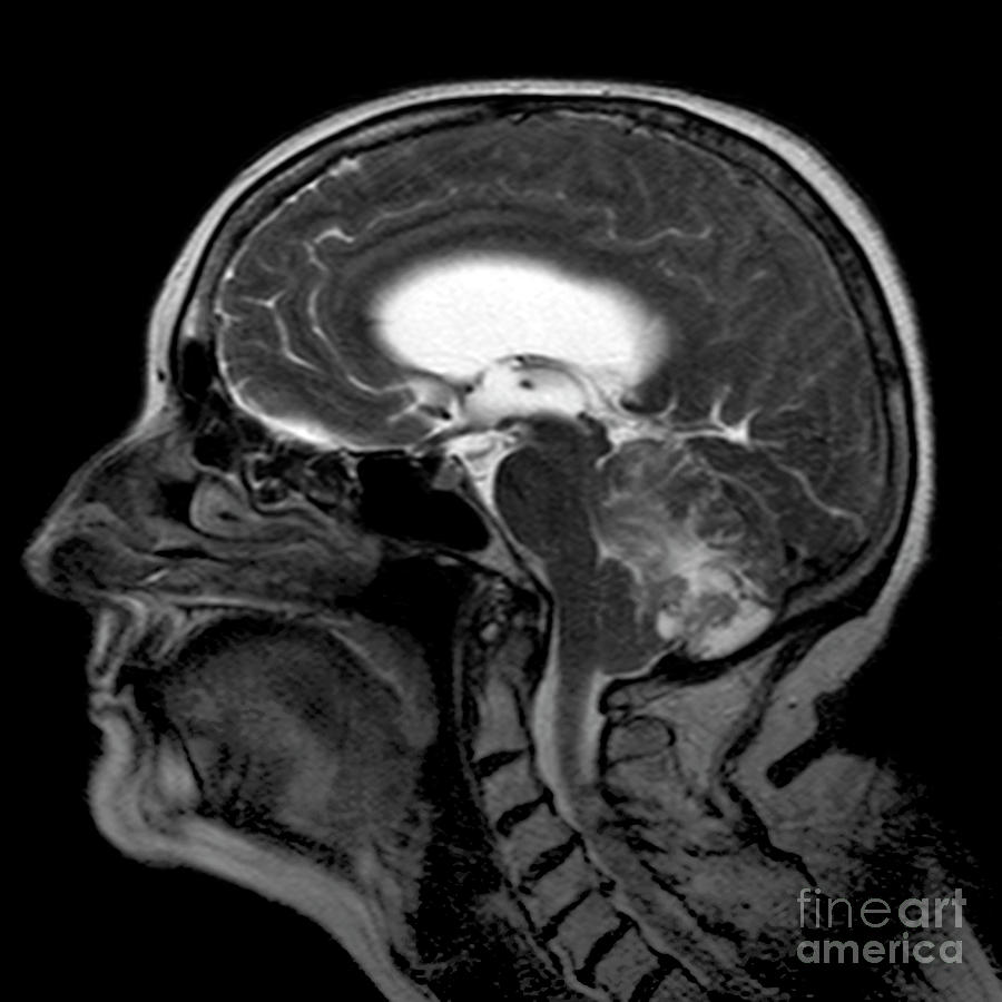 Haemangioblastoma Brain Tumour #8 Photograph by Simon Fraser/science Photo Library