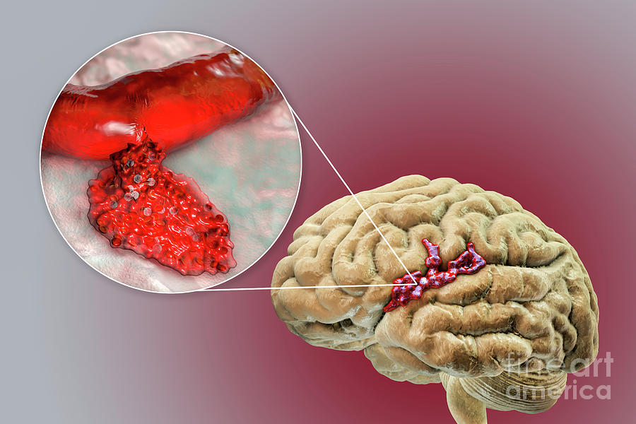 Haemorrhagic Stroke Photograph by Kateryna Kon/science Photo Library ...