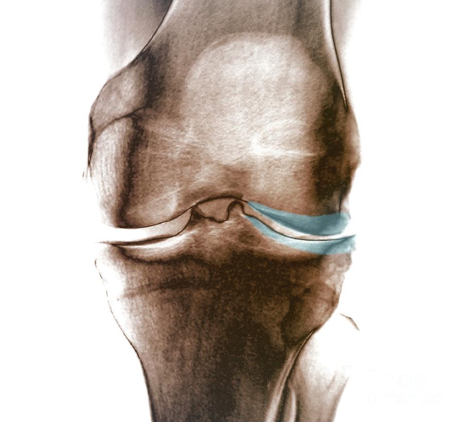 Knee Osteoarthritis Photograph by Zephyr/science Photo Library - Fine ...
