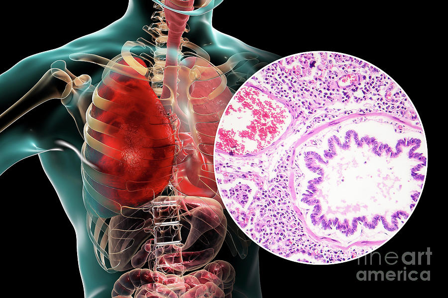 Lobar Pneumonia #8 Photograph by Kateryna Kon/science Photo Library ...