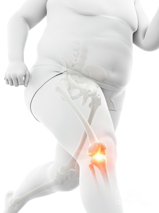 Sports Photograph - Obese Runner With Knee Pain #8 by Sebastian Kaulitzki/science Photo Library