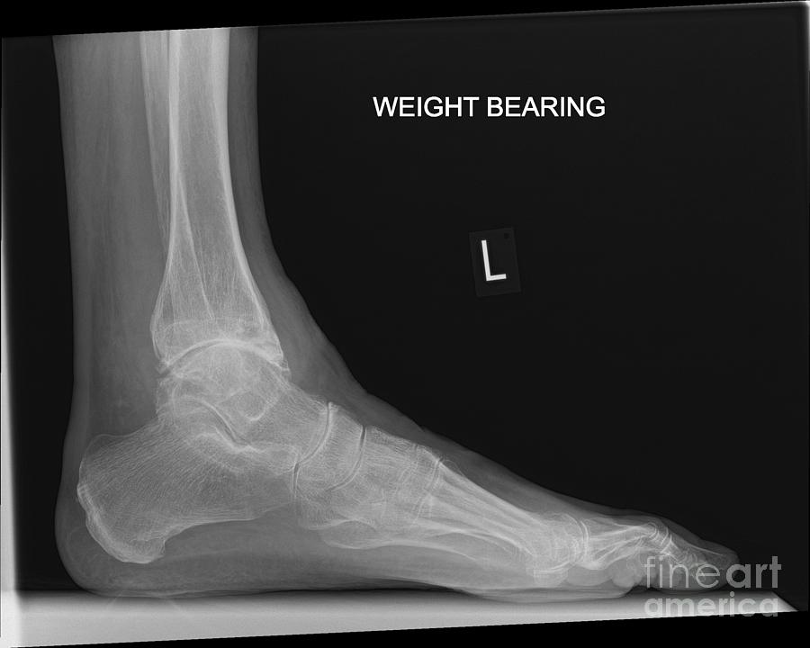 Osteoarthritis Of The Ankle Photograph By Dr P Marazzi Science Photo Library