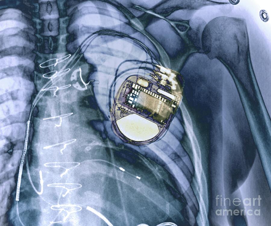 Pacemaker Photograph By Zephyrscience Photo Library Pixels