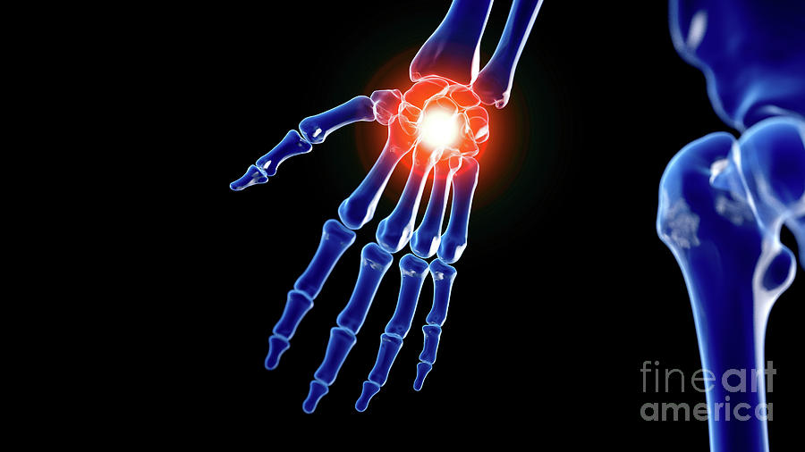 Painful Wrist #8 Photograph by Sebastian Kaulitzki/science Photo Library