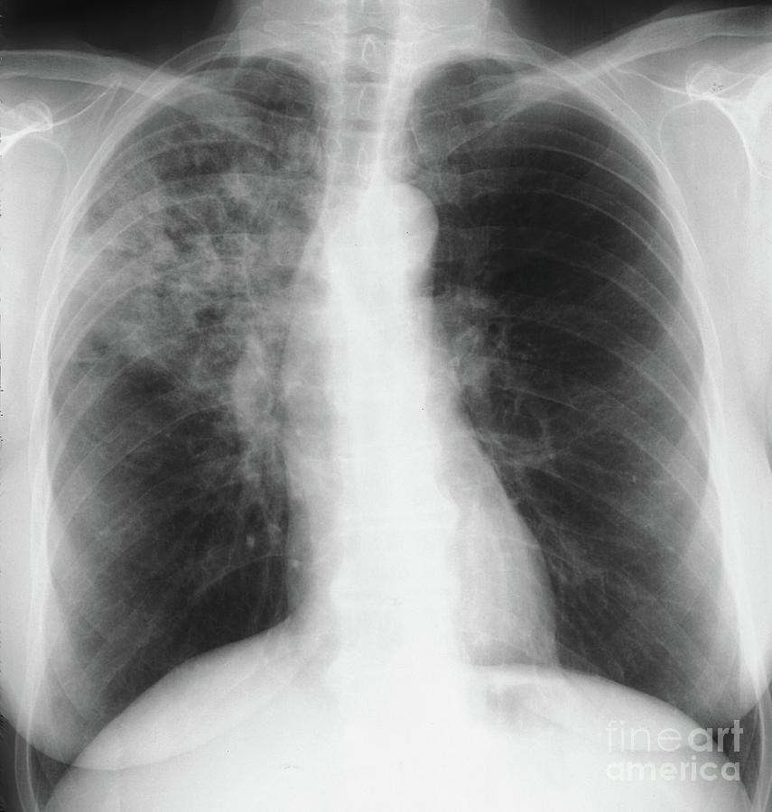 Pneumonia Photograph by Zephyr/science Photo Library - Fine Art America